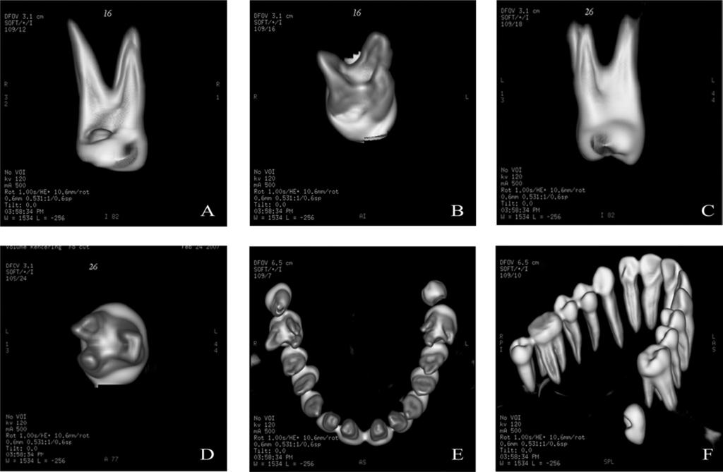 Volume 105, Number 4 Gopikrishna et al. e77 Fig. 3. A, B, 3-D reconstruction of tooth #3. C, D, 3-D reconstruction of tooth #14.