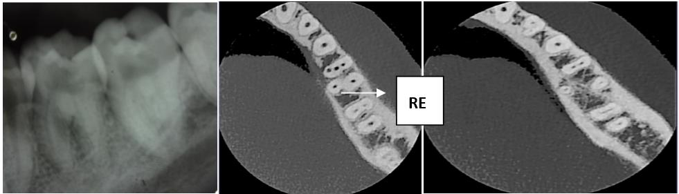 The transverse, axial, and sagittal CBCT sections of the involved tooth were taken [Fig. 2, 3]. The CBCT scan slices confirmed the presence of bilateral radix entomolaris.