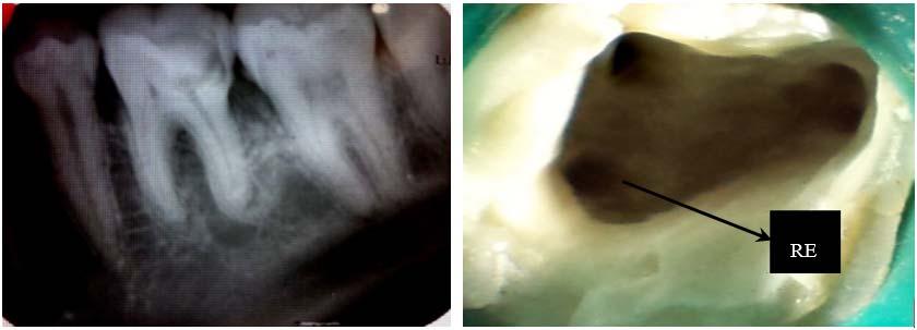 Diagnostic radiography showed a coronal radiolucent area involving the pulp and ill-defined radiolucency at the periapex of distal root.