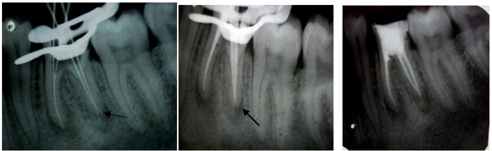 Fig 15, 16, 17: Working length, master cone and post obturation radiographs showing additional root. 4.