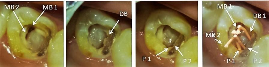 2) In later appointments cleaning and shaping was performed using endodontic K-files (Mallifer, Dentsply). Thorough irrigation was done with 2.5% sodium hypochlorite solution (NaOCl).
