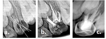 Fig. 2 b: Radiographs showing a. Working Length, b. Obturation, c.