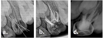 Fig. 4: Radiographical images showing a. working Length, b. obturation, d. Stainless Steel Crown adaptation on maxillary left second primary molar tooth.