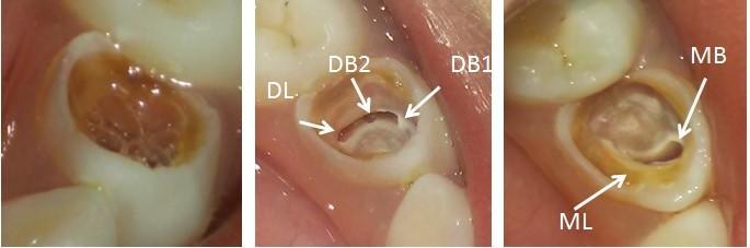 Clinical examination revealed a grossly carious left lower first primary molar. Radio-graphically caries was approaching pulp space and radiolucency involving roots was appreciated.