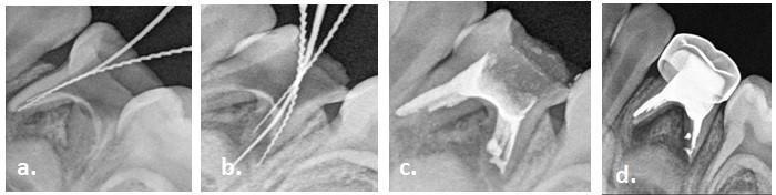 Fig. 6: Radiographical images showing a. working length of mesial roots, b. working length of distal root, c. obturation, c.