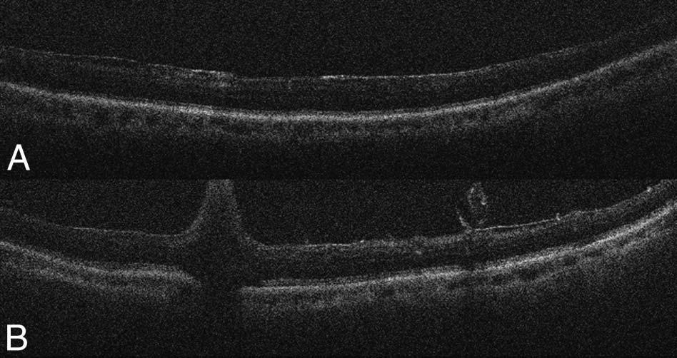 216 RETINA, THE JOURNAL OF RETINAL AND VITREOUS DISEASES 2014 VOLUME 34 NUMBER 2 Fig. 3. Case example of focal full-thickness retinal elevation at the site of initiation of membrane peeling. A. Before ILM peeling.