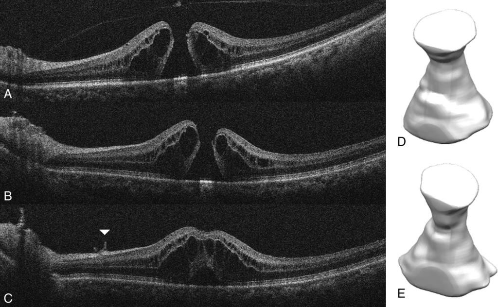 218 RETINA, THE JOURNAL OF RETINAL AND VITREOUS DISEASES 2014 VOLUME 34 NUMBER 2 Fig. 5. Case 15.