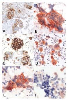 Utility of diagnostic materials Histology vs cytology (only PDL1 on histological tissue approved) Paired Comparison of PD-L1 Expression on 86 Cytologic (cell blocks) and Histologic Specimens From