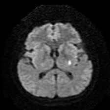 Stroke Stroke Megan Stevens MD Vascular Neurology SUDDEN Maximal at onset Lateralized weakness, lateralized numbness, vision loss (one eye or portion of field in both eyes), double vision, slurred