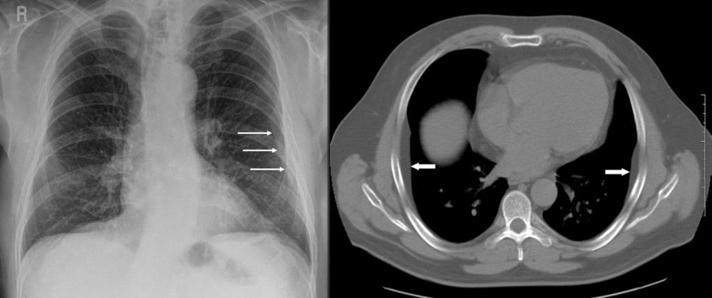 Fig. 9: CXR on left displaying right sided mesothelioma with circumferential pleural thickening and loss of volume.