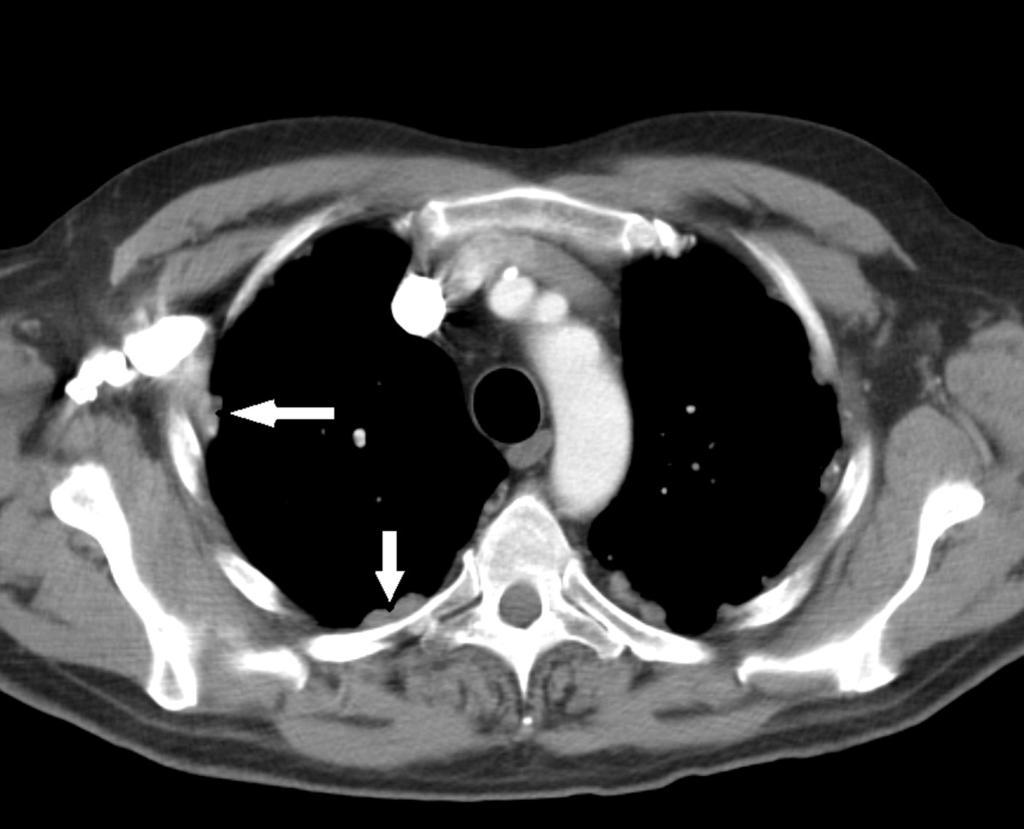 Fig. 3: Arrows indicating non calcified