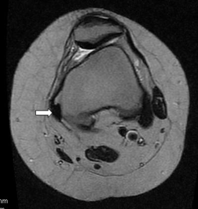 Axial fast relaxation fast spin echo (FRFSE) T2 MRI, showing calcification in the 
