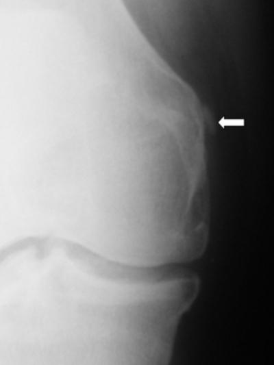 calcification adjacent to the medial femoral epicondyle (arrow).