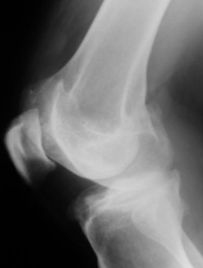 Figure 14 Figure 14: Pellegrini-Stieda Syndrome (Patient DK) showing associated osteoarthritis. within the calcified segment of the MCL.