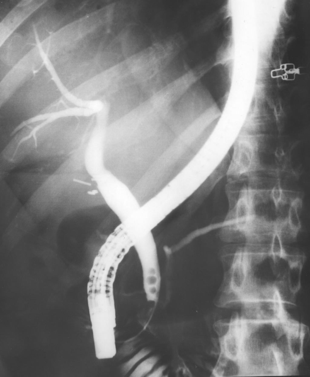 Endoscopic scissors were passed through the epigastric port, and the cystic duct was incised along one-half its circumference just distal to the previously placed titanium clip.