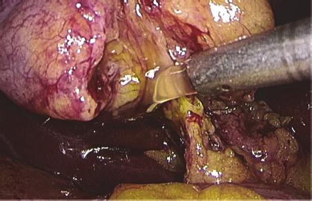 Gallbladder extraction is performed using a retrieval bag, subhepatic drainage is positioned, trocars removal is undertaken under vision, and trocar sites are sutured. 4.