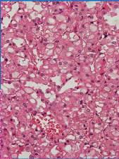 tool VS Metastasis Other kidney tumors, where we have to call genetist Anamnesis IHC