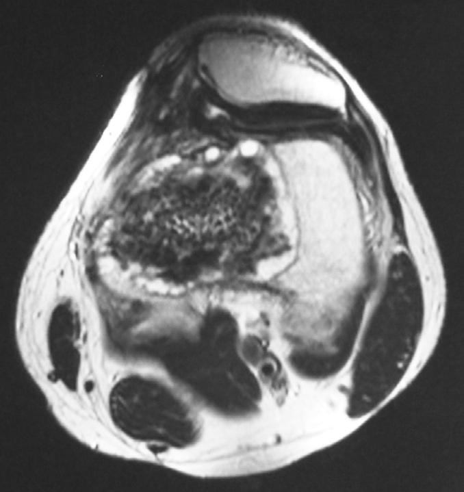 Figure 3 The right distal femur of a 30-year-old man 24 months after surgery: the granules of hydroxyapatite graft are homogenously incorporated; the centre of the graft