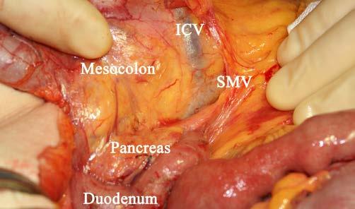 Figure 1: Table 1: Dissection plane Mesocolic Intramesocolic Muscularis propria There should be an intact and smooth mesocolic surface with only minor irregularities.