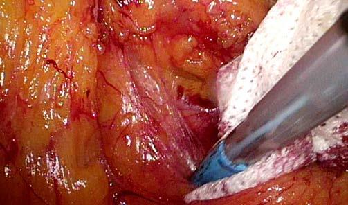 There should be smooth retroperitoneal and mesocolic resection margins on the cross-sectional slices There may be moderate bulk to the mesocolon but significant irregularity of the peritoneal or