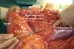 and sometimes even the anterior pancreaticoduodenal vein (referred to as pancreatic branch by some) [51, 62-64] The SMV is the landmark in both open and laparoscopic CME surgery and, as it is