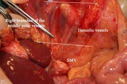 The mesocolic LNs are contained within the mesocolic fascia and follow the supplying arteries [65].