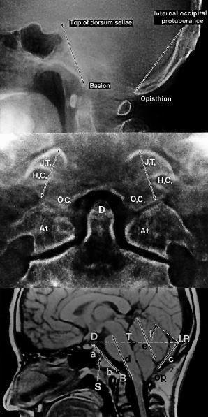 Lower: A T1-weighted sagittal MR image showing the midline structures of the posterior cranial fossa and the brainstem and cerebellum.