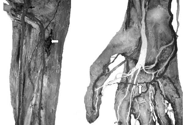 Sujatha D Costa et al., Superficial arteries of the upper limb AU CIT PU N DPA IA AIA PIA PP I SPA A A B Figure 2 A.