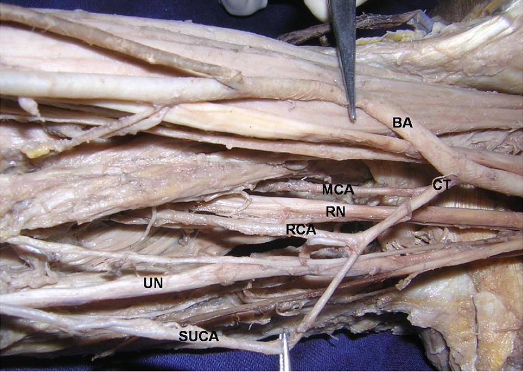 Common trunk of the profunda brachii