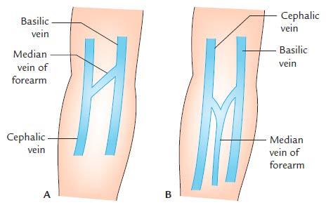 Figure 35: The H-shaped & M-shaped arrangement of superficial veins at the cubital fossa Proximal to the cubital fossa, the basilic and cephalic veins ascend the medial and lateral sides of the arm