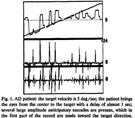 Anticipatory saccades We found that the strongest difference between AD patients and the controls involved the number and the total amplitude of anticipatory saccades.