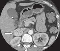 W.R. Hwang, et al A B C D Figure 1. (A) Contrast-enhanced computed tomography reveals a heterogeneous mass (arrow) in the right adrenal gland.