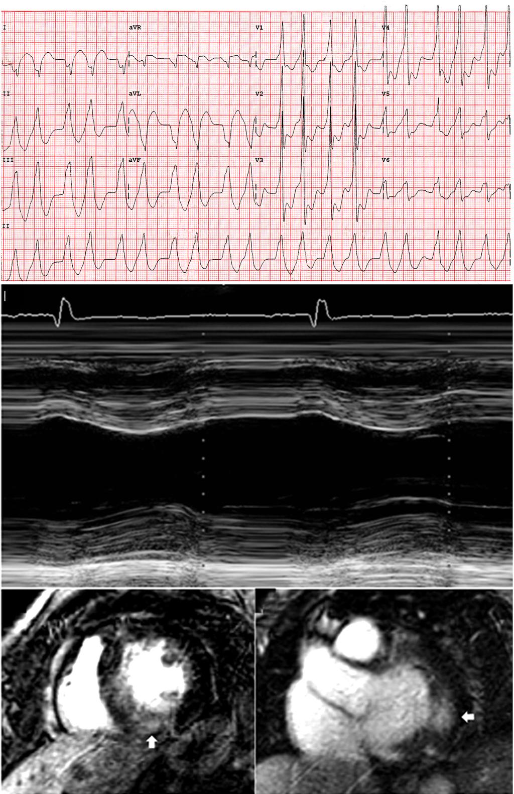 Chin-Yu Lin, et al. 527 A B C D Fig. 1. Electrocardiographic morphologies of ventricular arrhythmia and echocardiography in a patient with severe concentric left ventricular hypertrophy (LVH).