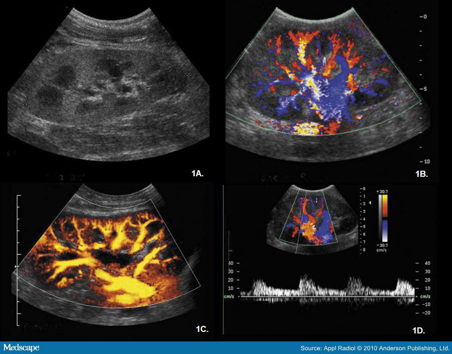From Doppler Ultrasound Evaluation of Renal Transplants by