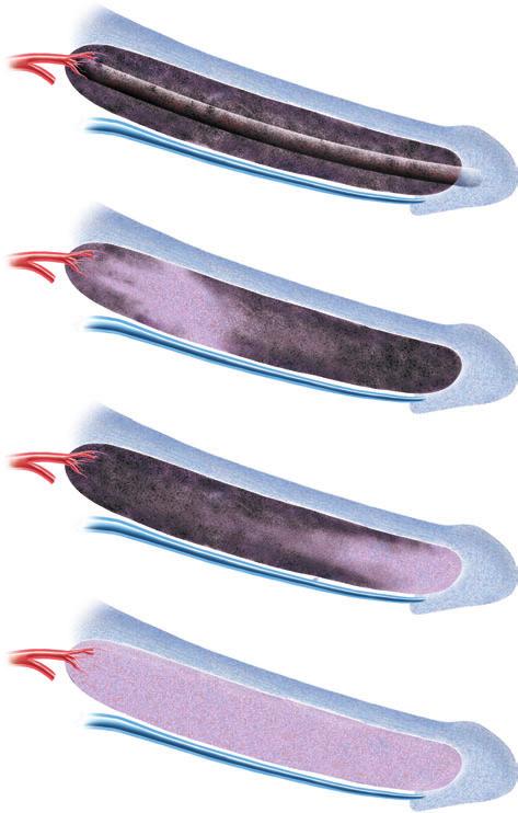 GARCIA ET AL. Figure 1 Figure 1. In pripism of 1 2 dys durtion, moderte oedem of the erectile tissue within the corpor cvernos is expected.