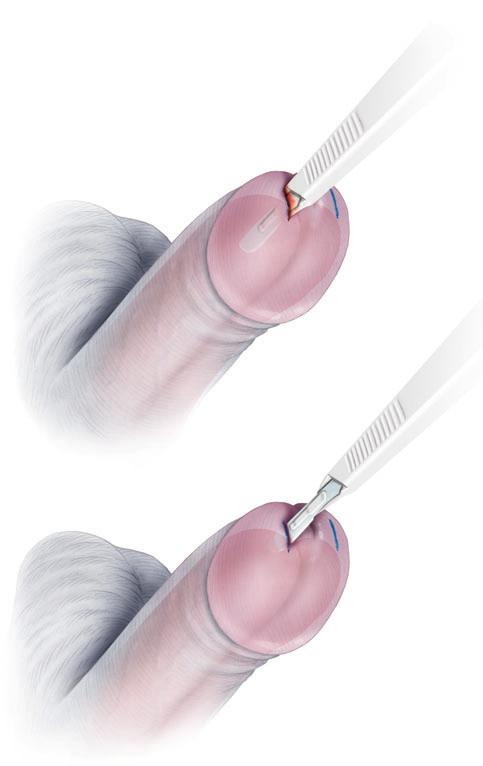 GARCIA ET AL. Figures 3 nd 4 The #10-lde sclpel is positioned verticlly nd prllel to the urethrl metus over the mrked glns incision site. The lde cn e fcing up or down, dependng on surgeon preference.