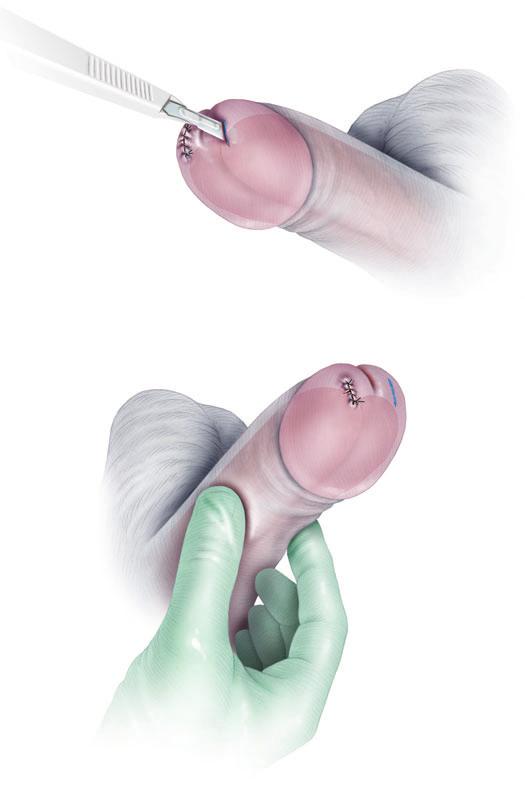 SURGERY ILLUSTRATED Figure 6 The rigidity of the penis is ssessed y using the thum nd index fingers to squeeze the corpor cvernos together t the level of the penile mid-shft.