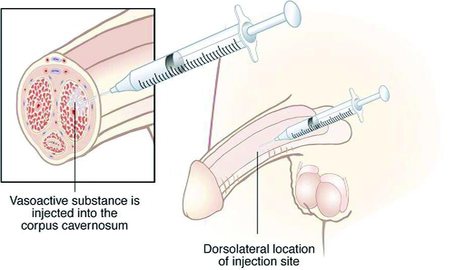 Intracorporal Injection PGE-1 (Cavarject) 10-40 mcg q 24 hour dosing efficacy 80% side effects: penile aching hematoma