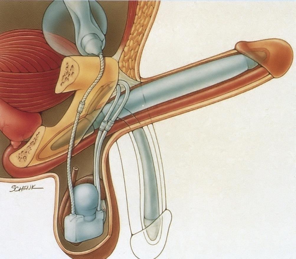 Inflatable Penile Prosthesis (IPP) disadvantages: device failure erosion infection auto-inflation SST deformity
