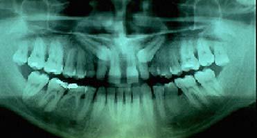 A 30 year-old male, heavy smoker,(fig.1) was referred to the orthodontist by his family dentist.