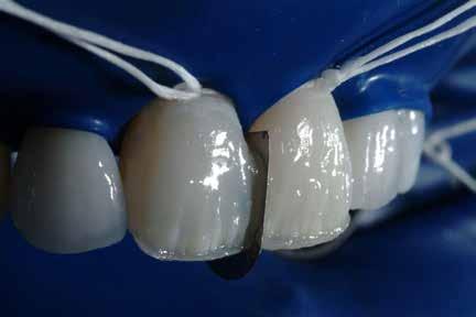 Friday Update in anterior bonded restorations Through the knowledge of dental morphology, function, biomechanics and