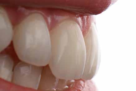The symbiotic relation of enamel, dentin and the dentinoenamel complex can be approached by the synergistic use of