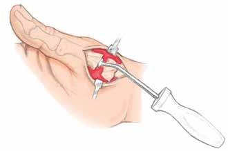 If the thumb cannot be brought to the full range of abduction without undue force, the joint has been under spaced and must be corrected by resecting an additional appropriate amount of bone from the