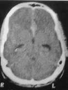 Fig-1A: Brain CT scan: