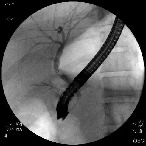 Gallstone disease Stricture dilation
