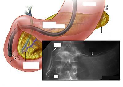 ERCP Pancreatic Cannulation common bile duct (CBD) CBD stomach PD pancreas
