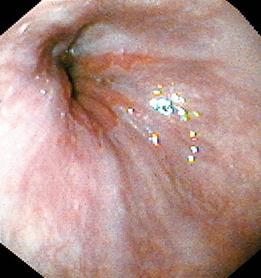 Gastroesophageal Junction Located at 35-40 cm from the incisors Squamocolumnar junction = Z-line