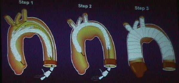 stent-graft implantation for thoracic aortic aneurysm or