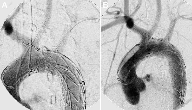 J ENDOVASC THER 2009;16:457 463 Endovascular Repair of Acute Traumatic Thoracic Aortic