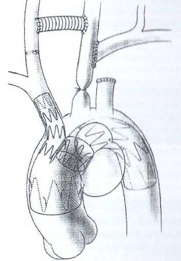 graft for endovascularrepair of aortic arch